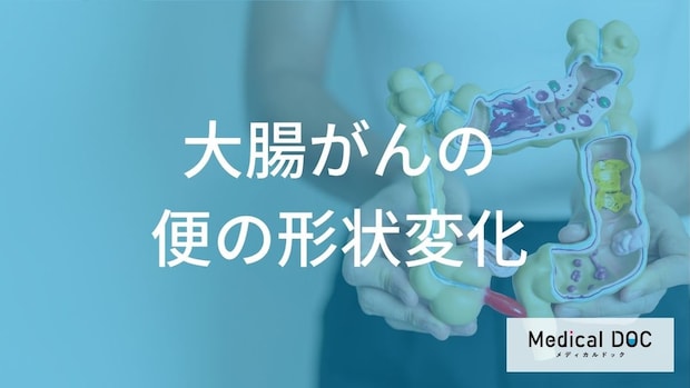 【要注意】数週間続く「細い便」は大腸がん？見逃しがちな初期症状と腸内で起きている異常