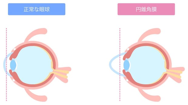 円錐角膜とは？