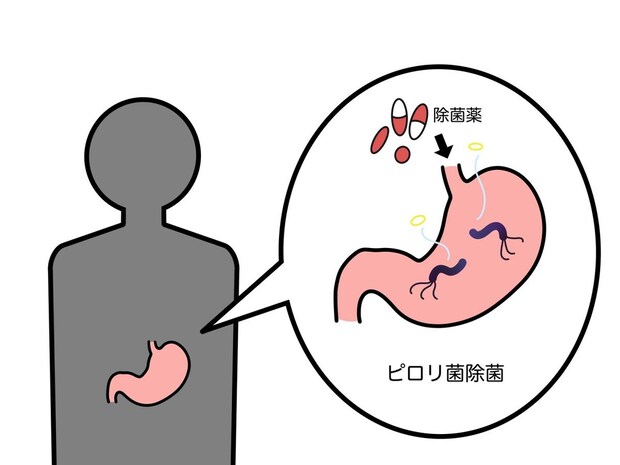 慢性胃炎の治療法・予防法