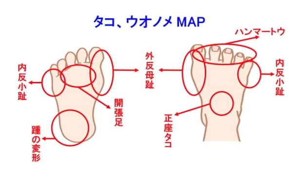 タコ、ウオノメMAP
