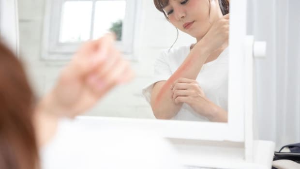 【闘病】「なぜ私が…」終わらない難病『SLE』の苦悩。理解されない孤独と母の不安