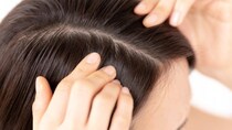 分け目が目立つのは『FAGA』のサイン？ 女性の薄毛の原因とは？【医師監修】
