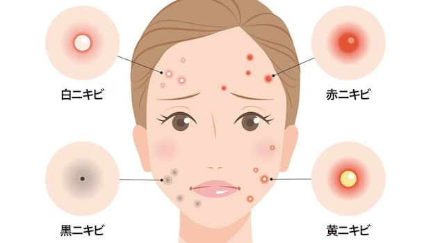 「白・黒・赤・黄」ニキビの色は”進行段階”を表す？ 違いと対処法を医師が解説