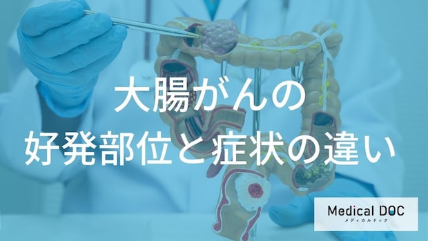 「大腸がん」の初期症状は“あの変化”？発見を左右する３つのサイン【医師監修】