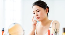 『クレーター』や『赤み』は治る？ 『ニキビ跡』に適した施術とは？【医師解説】