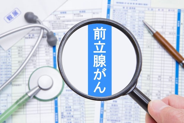 悪玉コレステロールと前立腺がん