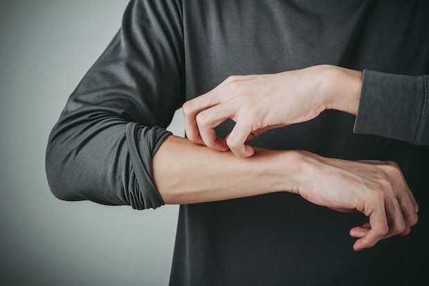 【闘病】全身の97%で汗が出なくなった難病の『無汗症』 サウナで気づいた異変