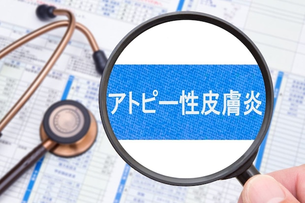 アトピー性皮膚炎とは？