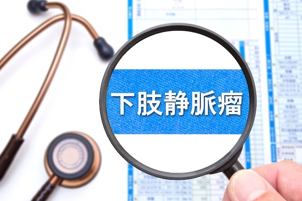 下肢静脈瘤とはどのような病気？