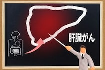 「肝臓がん」とは？症状・原因・検査法についても解説！