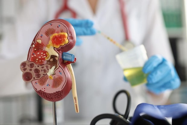 糖尿病性腎症の基礎知識
