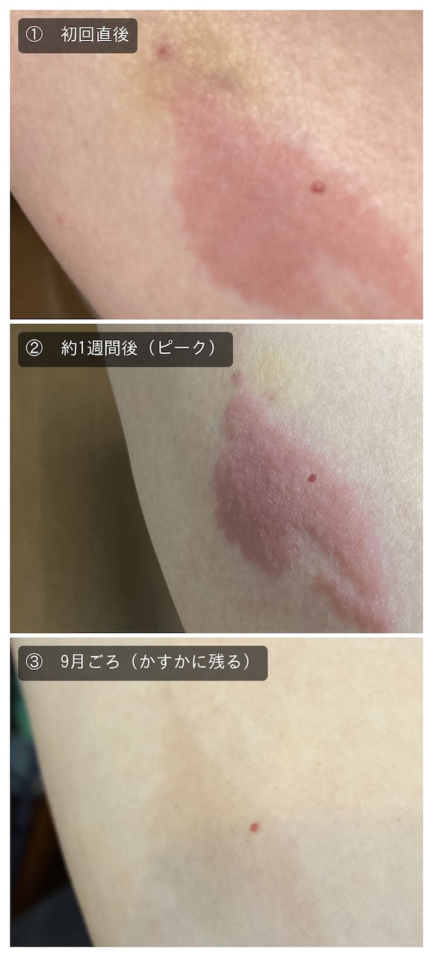 初回の抗がん剤点滴で起きた血管炎の経過。上から初回直後・約1週間後（ピーク）・9月ごろ。あらわれ方や回復の経過には個人差があります。
