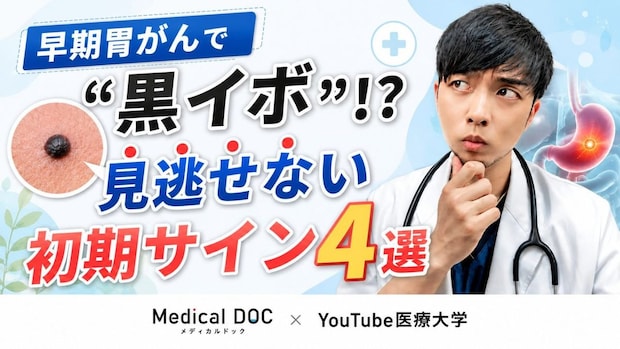早期胃がんで“黒イボ”!? 「見逃せない初期サイン4選」と、何歳からでもできる『2つの予防戦略』