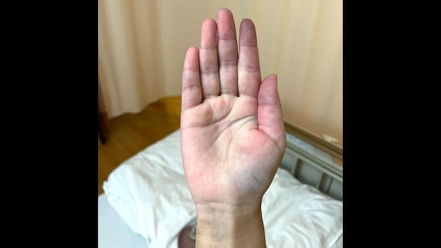 副作用は大変だが症状は落ち着きつつある