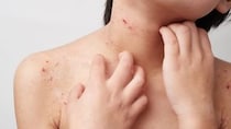 子どものアトピー性皮膚炎、受診は「小児科」or「皮膚科」？ 役割の違いを医師が解説