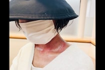 【闘病】治らない口内炎は舌がんだった。30歳元CAを襲った転移・再発と過酷な副作用のリアル