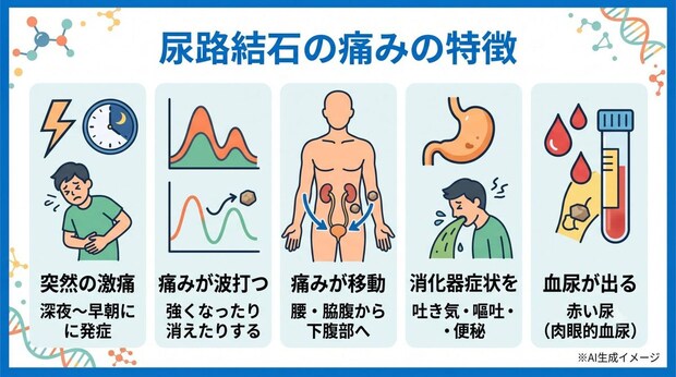 尿路結石による痛みの特徴