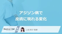 「アジソン病」を発症すると「皮膚」にどんな症状が現れるかご存知ですか？【医師監修】