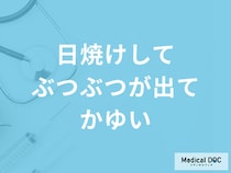 「日焼けしてぶつぶつが出てかゆい」ときの対処法は？日焼け止めについても解説！
