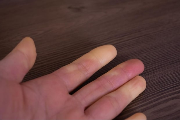膠原病の皮膚症状|見た目の特徴