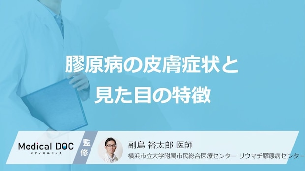 「膠原病」を発症すると「皮膚にどんな見た目」の変化が現れるかご存知ですか?【医師監修】