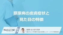 「膠原病」を発症すると「皮膚にどんな見た目」の変化が現れるかご存知ですか？【医師監修】