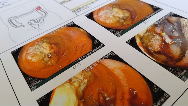 【闘病】父は45歳で他界「やっぱりきたか」市民ランナーに『大腸がん』ステージ3C