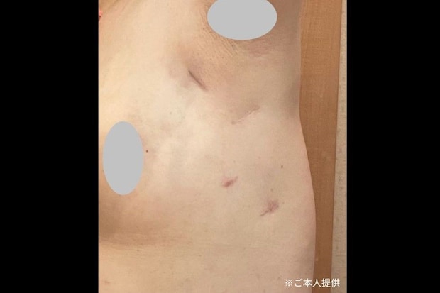 ホルモン療法のための薬