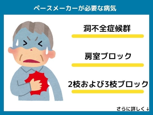 どんな病気に罹患するとペースメーカーが必要になる?