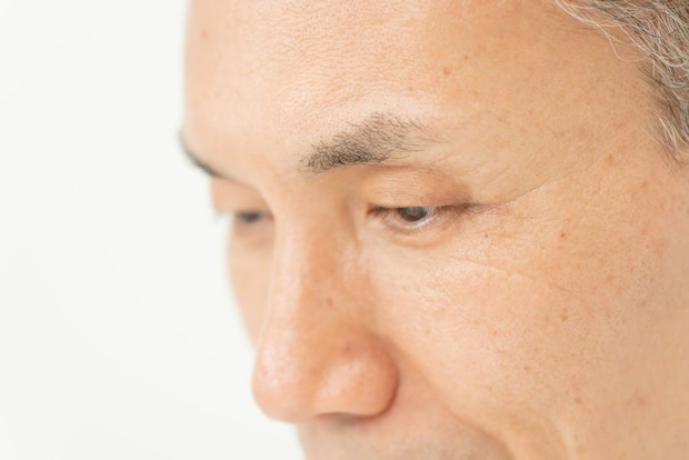 眼瞼下垂と治療の基本