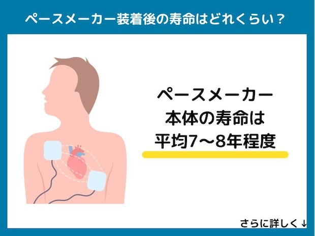 ペースメーカー装着後の寿命はどれくらい？