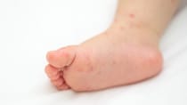 熱が下がっても油断できない『手足口病』 便から”数週間”ウイルスが出る理由を医師が解説