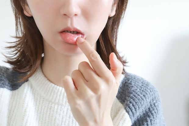 口内炎に使われる薬の種類
