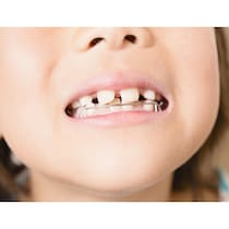 【矯正歯科トラブル】「子どもの矯正歯科は手軽」の落とし穴！ 親が知っておきたい小児の矯正歯科治療の正しい知識