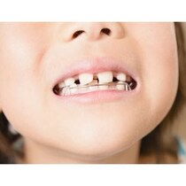 【専門家が解説】「子どもの矯正歯科は手軽」の落とし穴！ 親が知っておきたい小児の矯正歯科治療の正しい知識