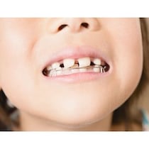 【専門家が解説】「子どもの矯正歯科は手軽」の落とし穴！ 親が知っておきたい小児の矯正歯科治療の正しい知識