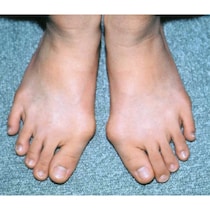 実は7割の子どもがサイズ間違い!? 間違った靴選びが招く一生モノの恐ろしい足トラブル