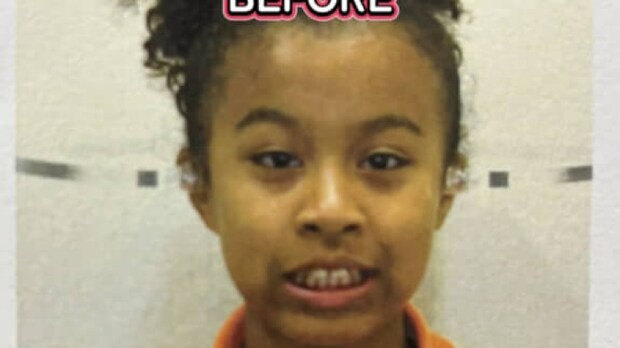 出っ歯すぎて口が開いていた子ども時代→母が100万かけて矯正してくれて……「変わりましたね」　“現在の姿”に感動「青春楽しんで」