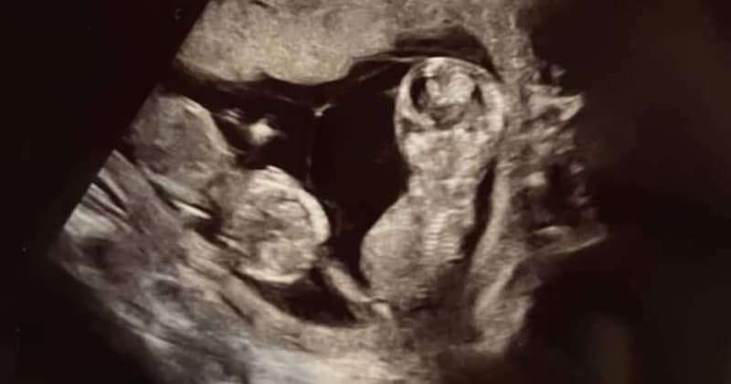 ママのお腹の中で寄り添う、双子の赤ちゃん→5年後……「うわぁ·····泣きそう」　姉妹の“現在の姿”に感動の声「たまらん」