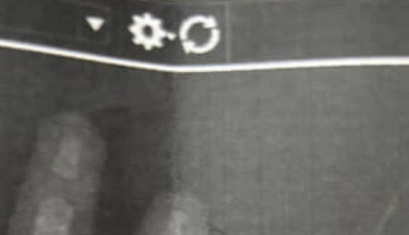 1歳息子の“レントゲン”を見たママ、思わず……　衝撃の光景に「スゴすぎて草」「初めて見ました」