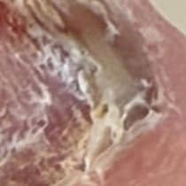 800キロの鉄骨に挟まれた“爪”→医師に「もう生えることはない」と言われ、30年後……　「人間ってすごい」“まさかの奇跡”に「泣けてくる」