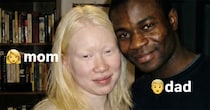 アルビノのママ＆ナイジェリア出身のパパから生まれた双子→23年後……　現在の姿が3980万再生「えっ、マジで？」「完璧な組み合わせ」【海外】