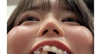 女性が“100万円の歯列矯正”に挑戦→たった1年で……「すげえ!!」　“衝撃のビフォアフ”が120万表示「こんなに……」