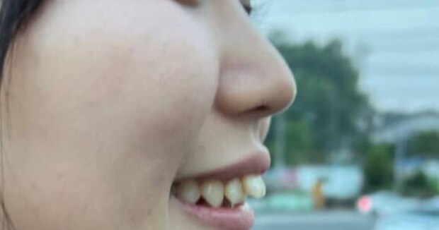 女性が“100万円の歯列矯正”に挑戦→1年後……「すごーい！」　驚きの変化に「同じ人？」「びっくり！」