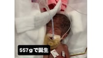 妊娠中、「消えてしまうかも」と言われた三つ子長男→557グラムで誕生し……　4カ月後の“現在の姿”に「生命力って凄い」「応援してます」