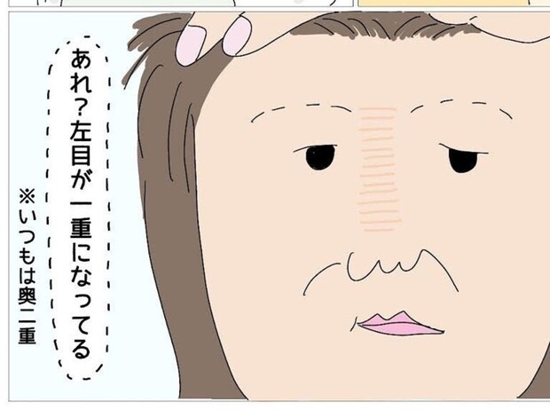 「あれ？左目が一重になってる」始まりは小さな違和感だった｜産後、顔面マヒを患った話