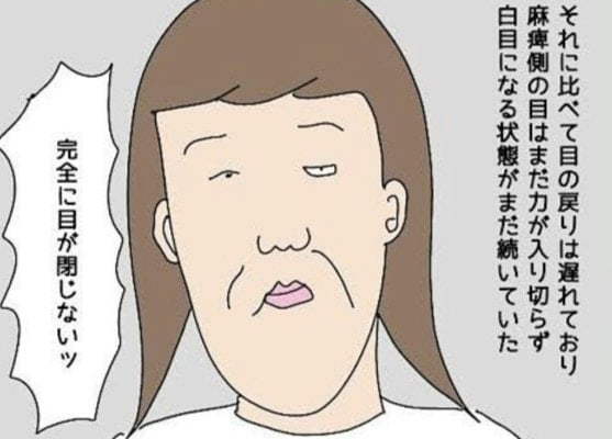 発症から2ヶ月、まだまぶたが下りない。完治が見えない恐怖｜産後、顔面マヒを患った話