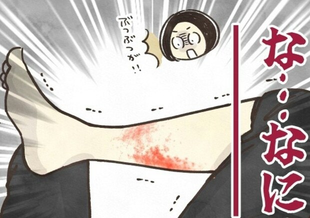 【ふくらはぎに湿疹】なにこれ!?違和感から始まった3年間の通院生活|血尿ものがたり